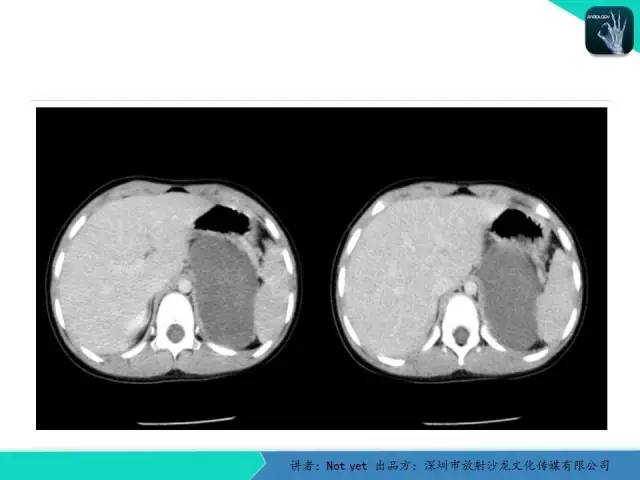 【病例】肾上腺节细胞神经瘤1例CT影像分诊断与鉴别