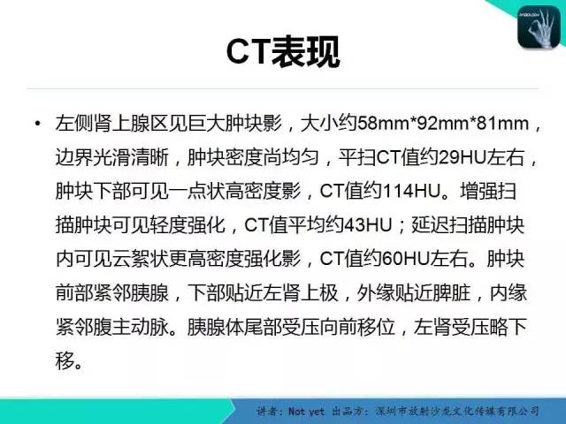 【病例】肾上腺节细胞神经瘤1例CT影像分诊断与鉴别