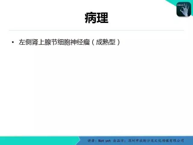 【病例】肾上腺节细胞神经瘤1例CT影像分诊断与鉴别