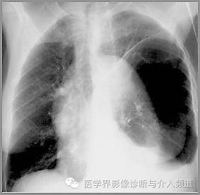 真假气胸,别再傻傻分不清! 真假气胸,别再傻傻分不清!