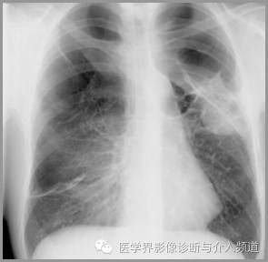 真假气胸,别再傻傻分不清! 真假气胸,别再傻傻分不清!