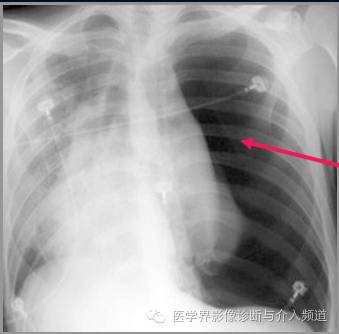 真假气胸,别再傻傻分不清! 真假气胸,别再傻傻分不清!