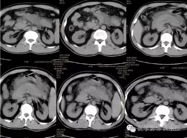 【PPT】急性胰腺炎CT评价