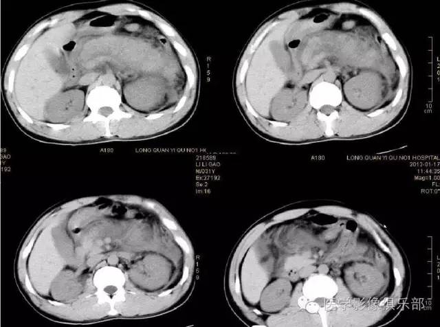 【PPT】急性胰腺炎CT评价