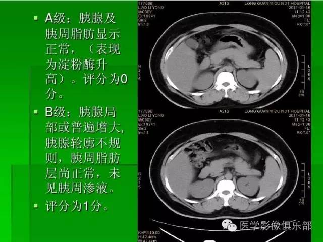 【PPT】急性胰腺炎CT评价