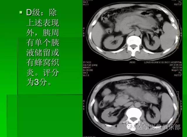 【PPT】急性胰腺炎CT评价