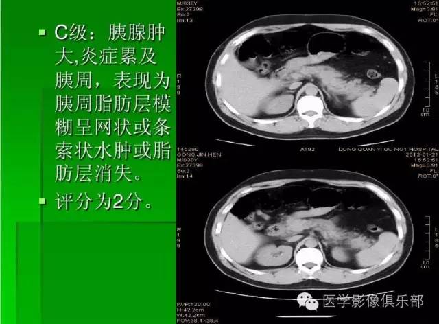 【PPT】急性胰腺炎CT评价