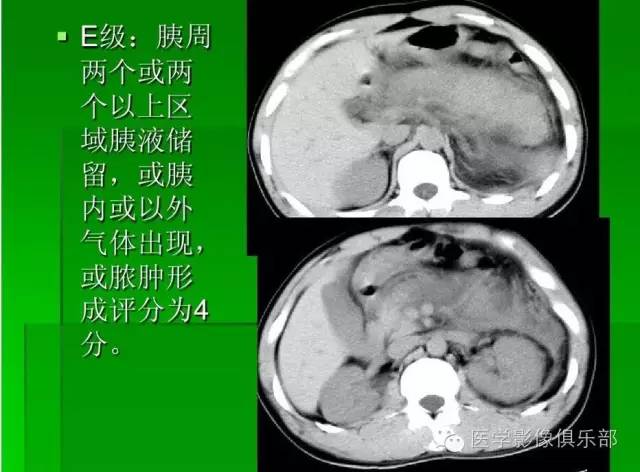 【PPT】急性胰腺炎CT评价