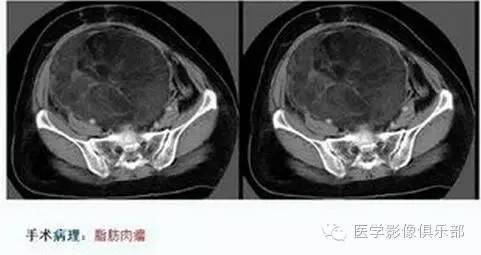 腹膜后含脂肪成分肿瘤或肿瘤样病变