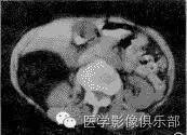 腹膜后含脂肪成分肿瘤或肿瘤样病变
