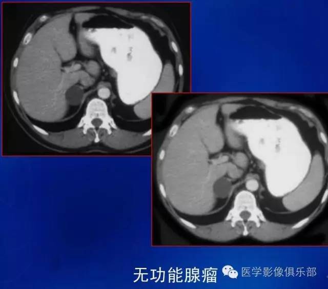 腹膜后含脂肪成分肿瘤或肿瘤样病变