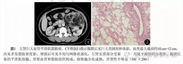 腹膜后含脂肪成分肿瘤或肿瘤样病变