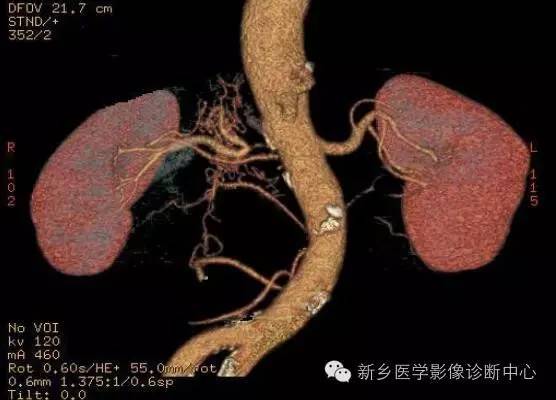 肾发育不全