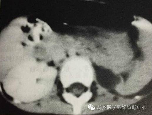 肾发育不良