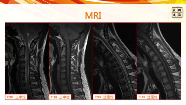 【病例】平山病1例MR影像表现