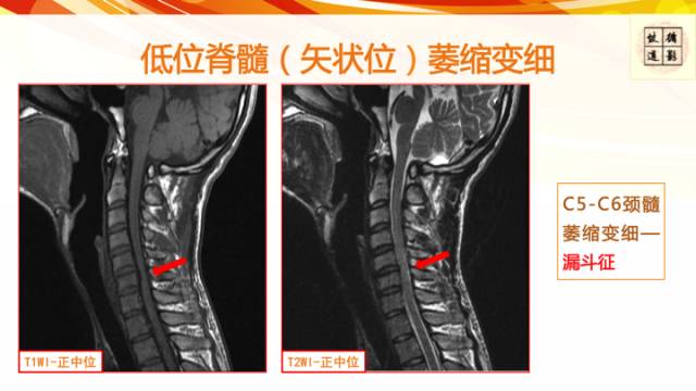 【病例】平山病1例MR影像表现