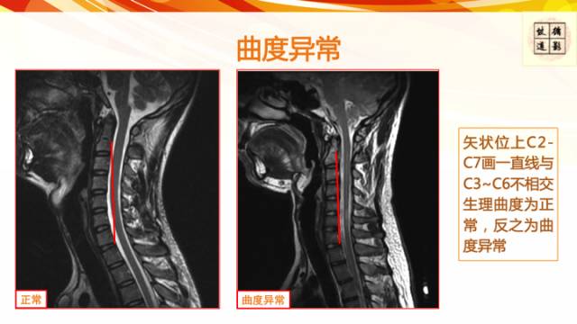 【病例】平山病1例MR影像表现