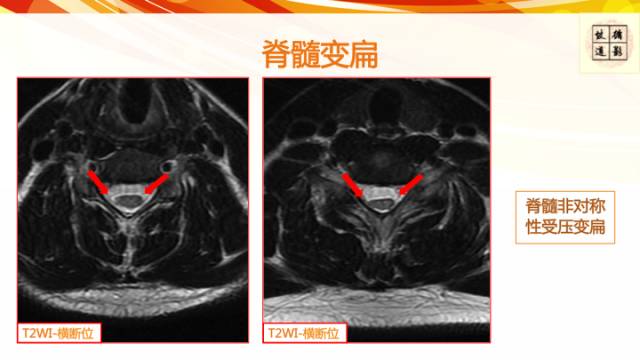 【病例】平山病1例MR影像表现