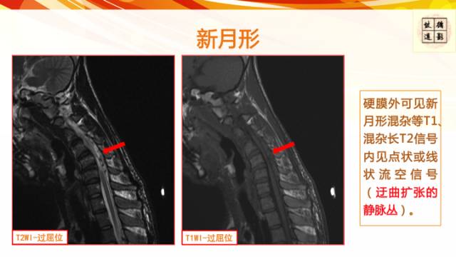 【病例】平山病1例MR影像表现