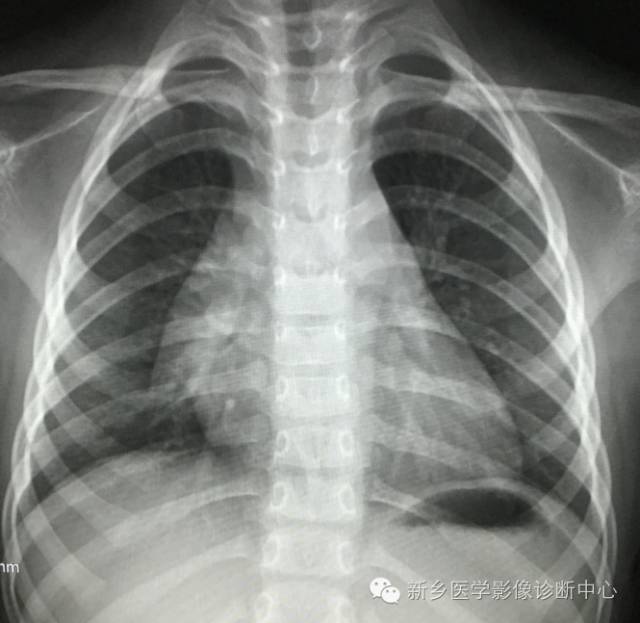 19幅胸腺图片，挑战您的见识