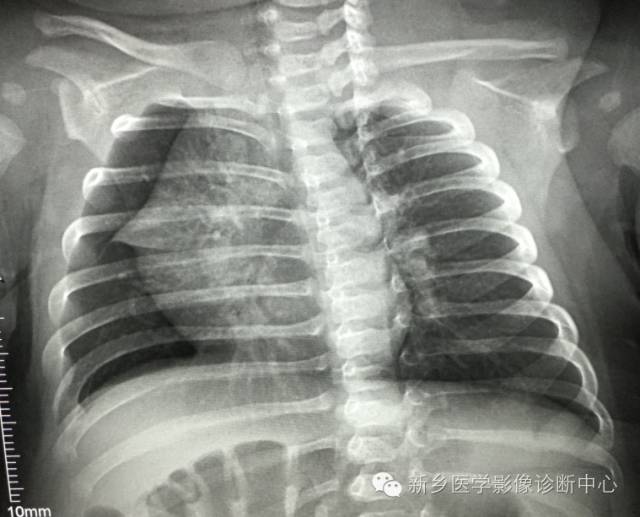 19幅胸腺图片，挑战您的见识