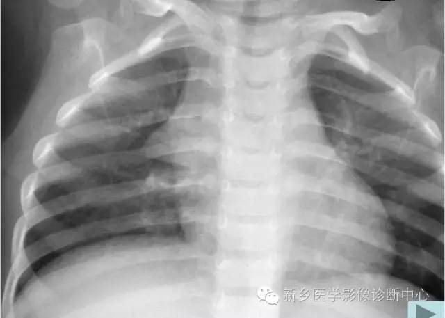 19幅胸腺图片，挑战您的见识