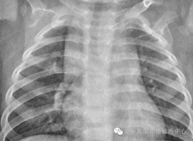 19幅胸腺图片，挑战您的见识