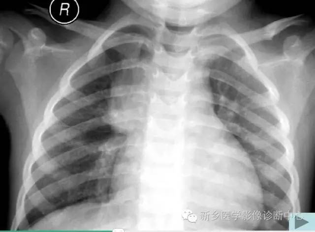19幅胸腺图片，挑战您的见识