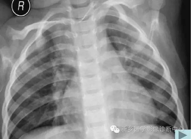 19幅胸腺图片，挑战您的见识