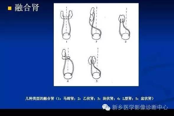 肾脏融合畸形 肾脏融合畸形