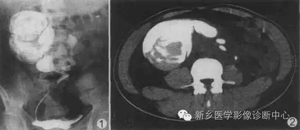 肾脏融合畸形 肾脏融合畸形