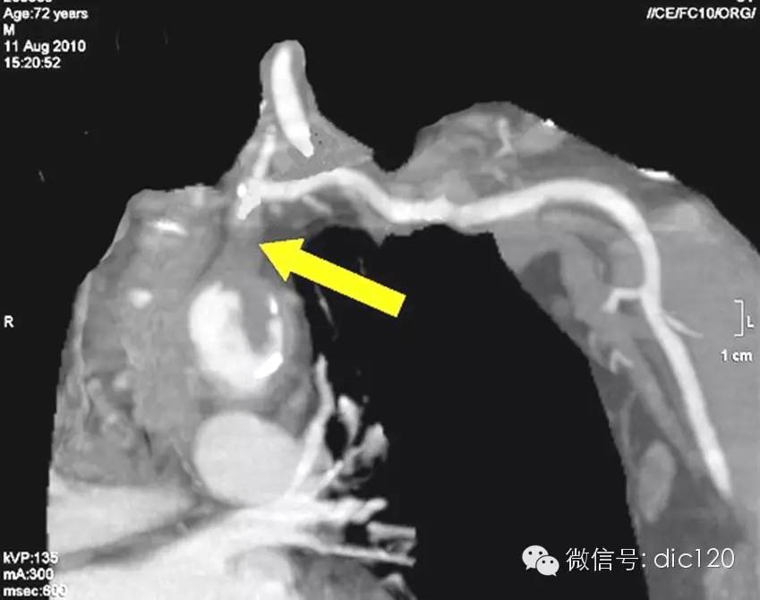 【病例】锁骨下动脉盗血综合征1例CT