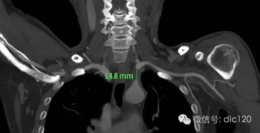 【病例】锁骨下动脉盗血综合征1例CT 【病例】锁骨下动脉盗血综合征1例CT
