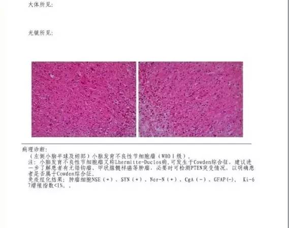 【病例】小脑发育不良性节细胞瘤1例MR 【病例】小脑发育不良性节细胞瘤1例MR