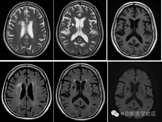 【病例实证】软化灶+脱髓鞘VS腔隙性脑梗死