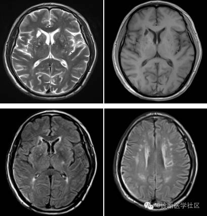 【病例实证】软化灶+脱髓鞘VS腔隙性脑梗死 【病例实证】软化灶+脱髓鞘VS腔隙性脑梗死