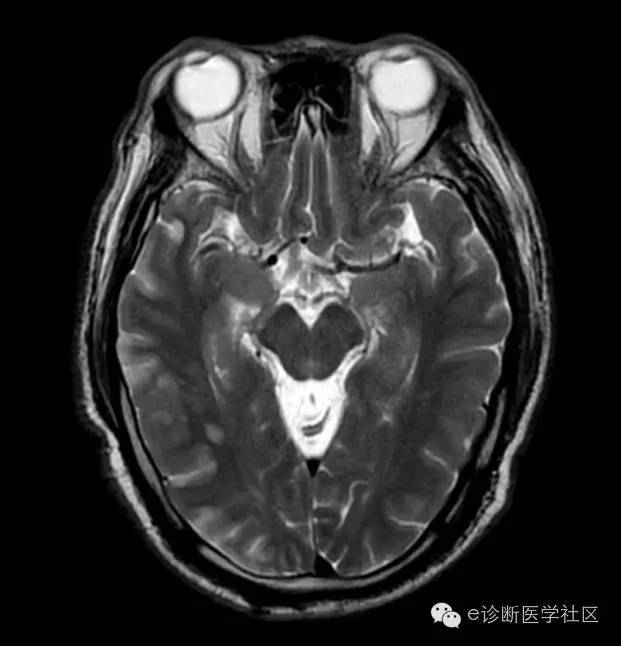 【病例】 脑梗死具体MR病例详实解读 【病例】 脑梗死具体MR病例详实解读