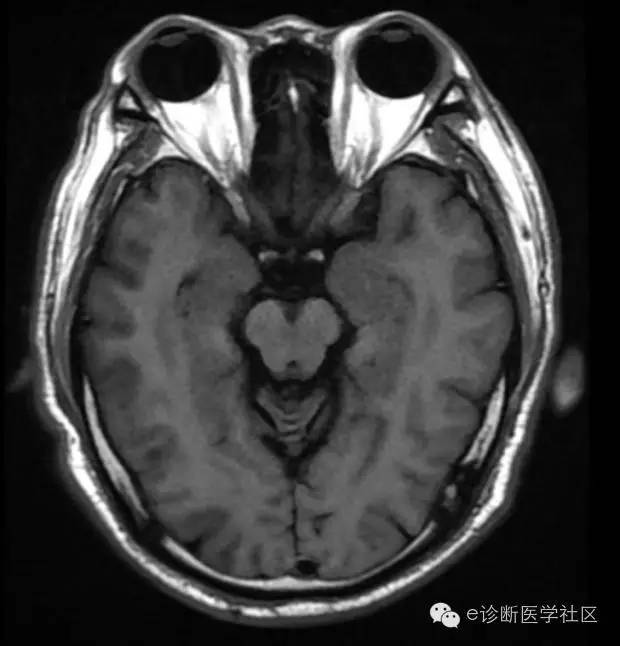 【病例】 脑梗死具体MR病例详实解读 【病例】 脑梗死具体MR病例详实解读