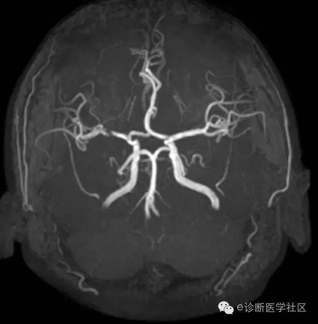 【病例】 脑梗死具体MR病例详实解读 【病例】 脑梗死具体MR病例详实解读