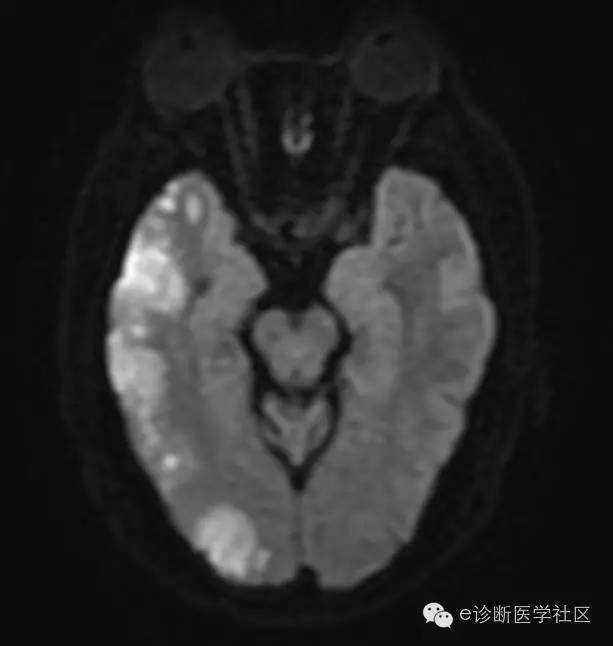 【病例】 脑梗死具体MR病例详实解读 【病例】 脑梗死具体MR病例详实解读