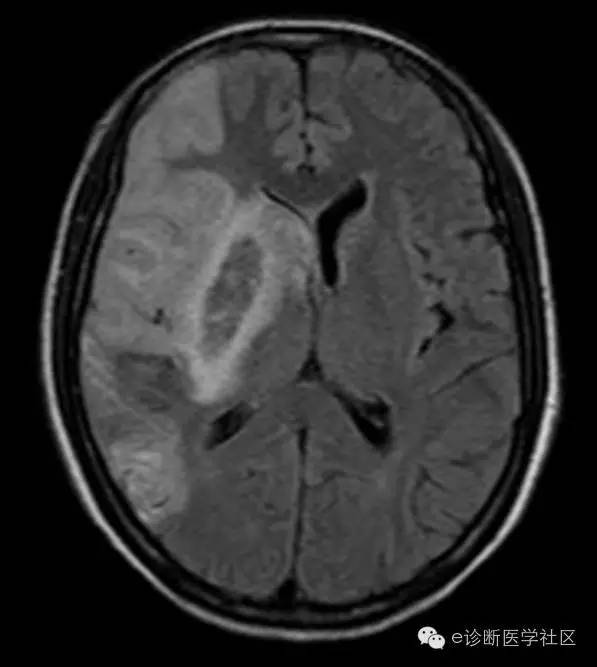 【病例】 脑梗死具体MR病例详实解读 【病例】 脑梗死具体MR病例详实解读