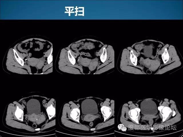 【病例】卵巢卵泡膜纤维瘤1例CT影像表现 【病例】卵巢卵泡膜纤维瘤1例CT影像表现