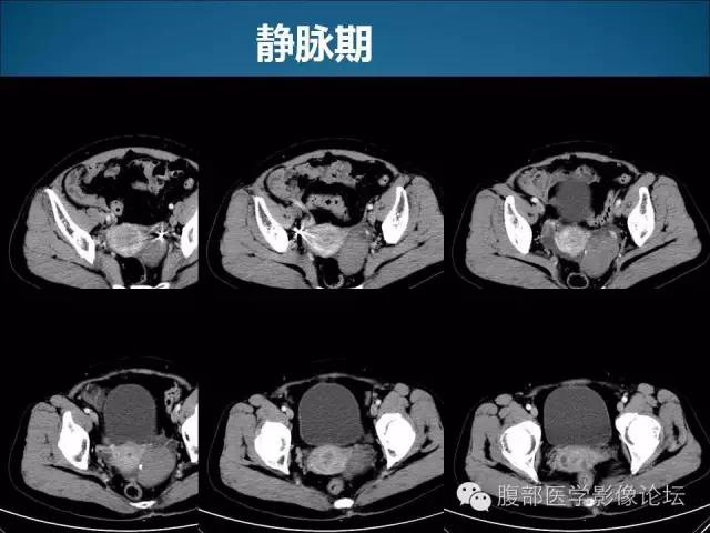 【病例】卵巢卵泡膜纤维瘤1例CT影像表现 【病例】卵巢卵泡膜纤维瘤1例CT影像表现