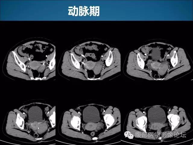 【病例】卵巢卵泡膜纤维瘤1例CT影像表现 【病例】卵巢卵泡膜纤维瘤1例CT影像表现