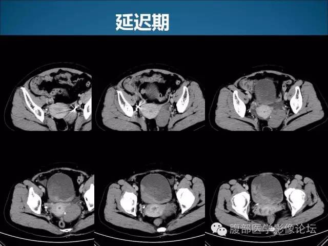 【病例】卵巢卵泡膜纤维瘤1例CT影像表现 【病例】卵巢卵泡膜纤维瘤1例CT影像表现