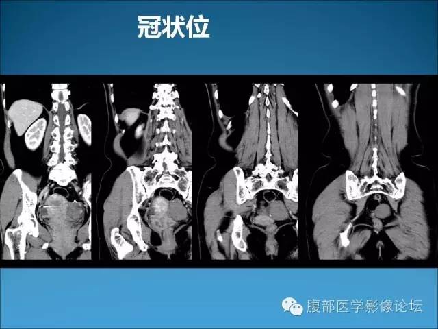 【病例】卵巢卵泡膜纤维瘤1例CT影像表现 【病例】卵巢卵泡膜纤维瘤1例CT影像表现