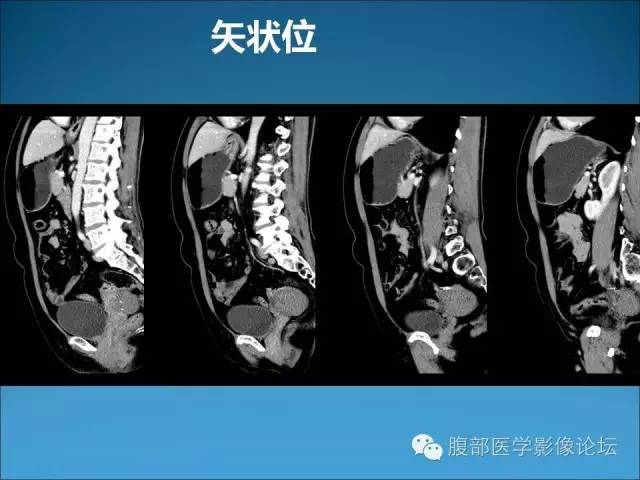 【病例】卵巢卵泡膜纤维瘤1例CT影像表现 【病例】卵巢卵泡膜纤维瘤1例CT影像表现