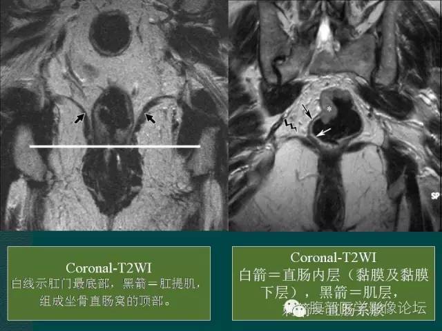 【PPT】直肠癌MRI分期
