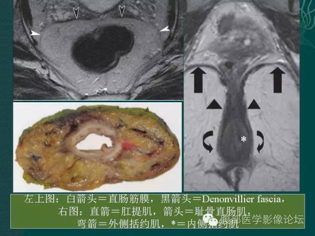 【PPT】直肠癌MRI分期