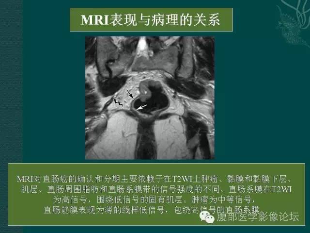 【PPT】直肠癌MRI分期